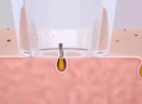 Multifunctional Cleaning Instrument – 4-in-1 Pore & Blackhead Remover in Pakistan